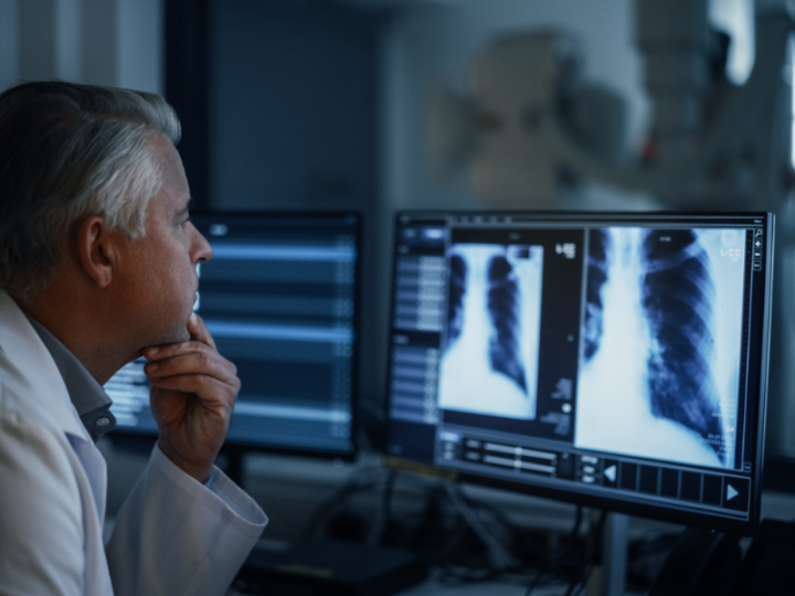 COVID-19’s Lingering Shadow: New Study Uncovers Molecular Link Between SARS-CoV-2 and Lung Cancer Risk