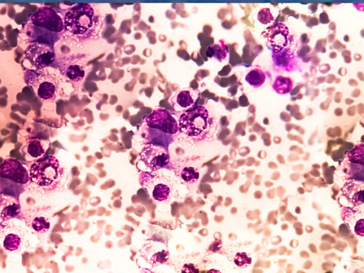 A protein shield stops cancerous skin cells from invading the rest of our body