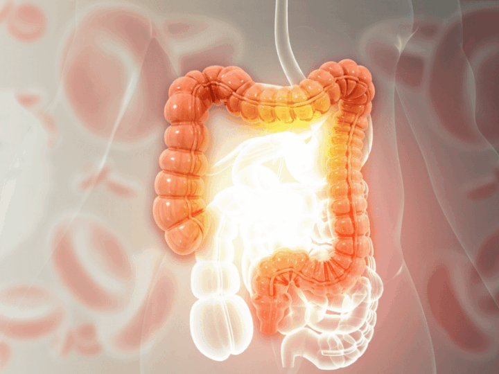 A New Map for IBD (Inflammatory Bowel Disease): Human DNA in Stool Reveals Disease Activity